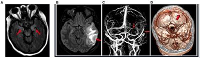 Acute Seizures Occurring in Association With SARS-CoV-2